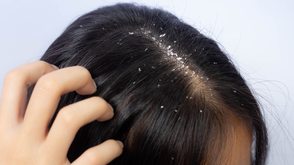 What Is Wet Dandruff And How Do I Treat It Trending