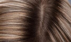 The Various Types Of Dandruff And How To Get Rid Of Them