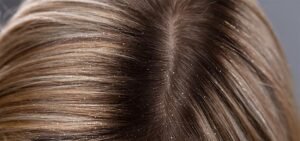 Read more about the article The Various Types Of Dandruff And How To Get Rid Of Them