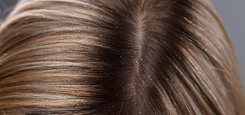 The Various Types Of Dandruff And How To Get Rid Of Them