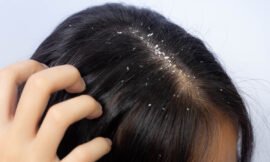 What Is Wet Dandruff And How Do I Treat It?